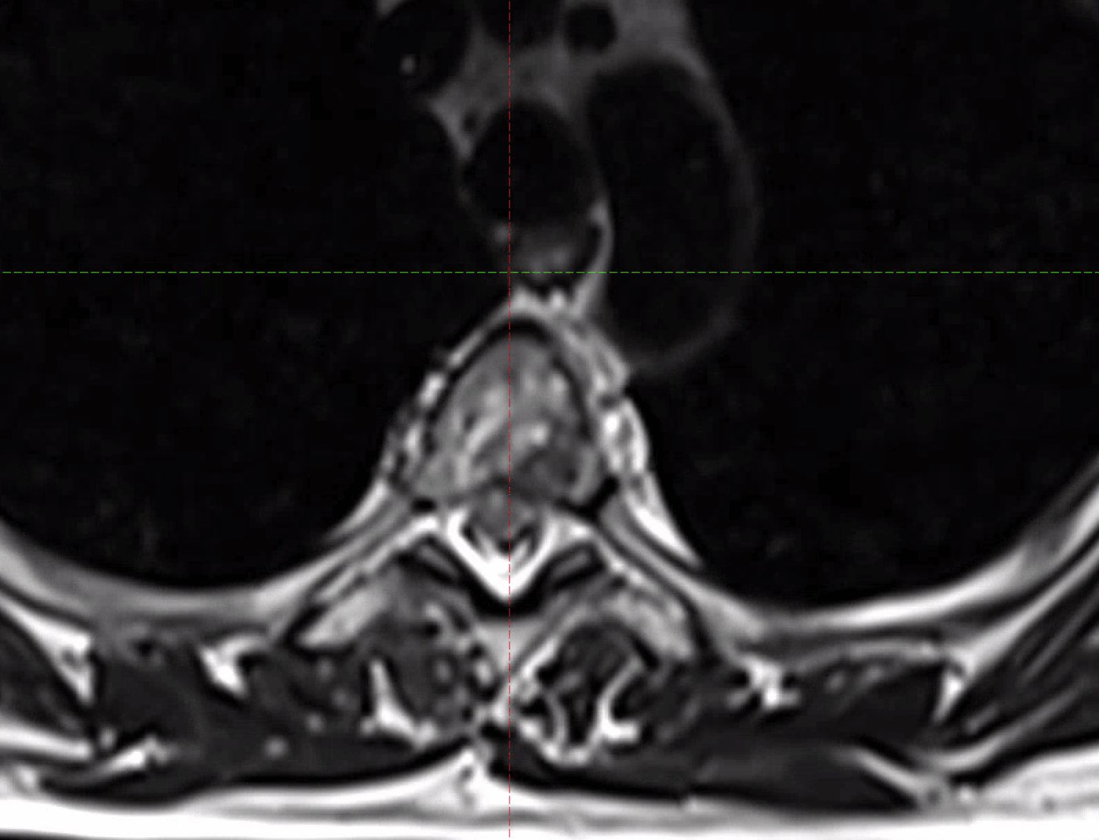 Early Spinal Metastasis with Intact Vertebra on a MRI Scan