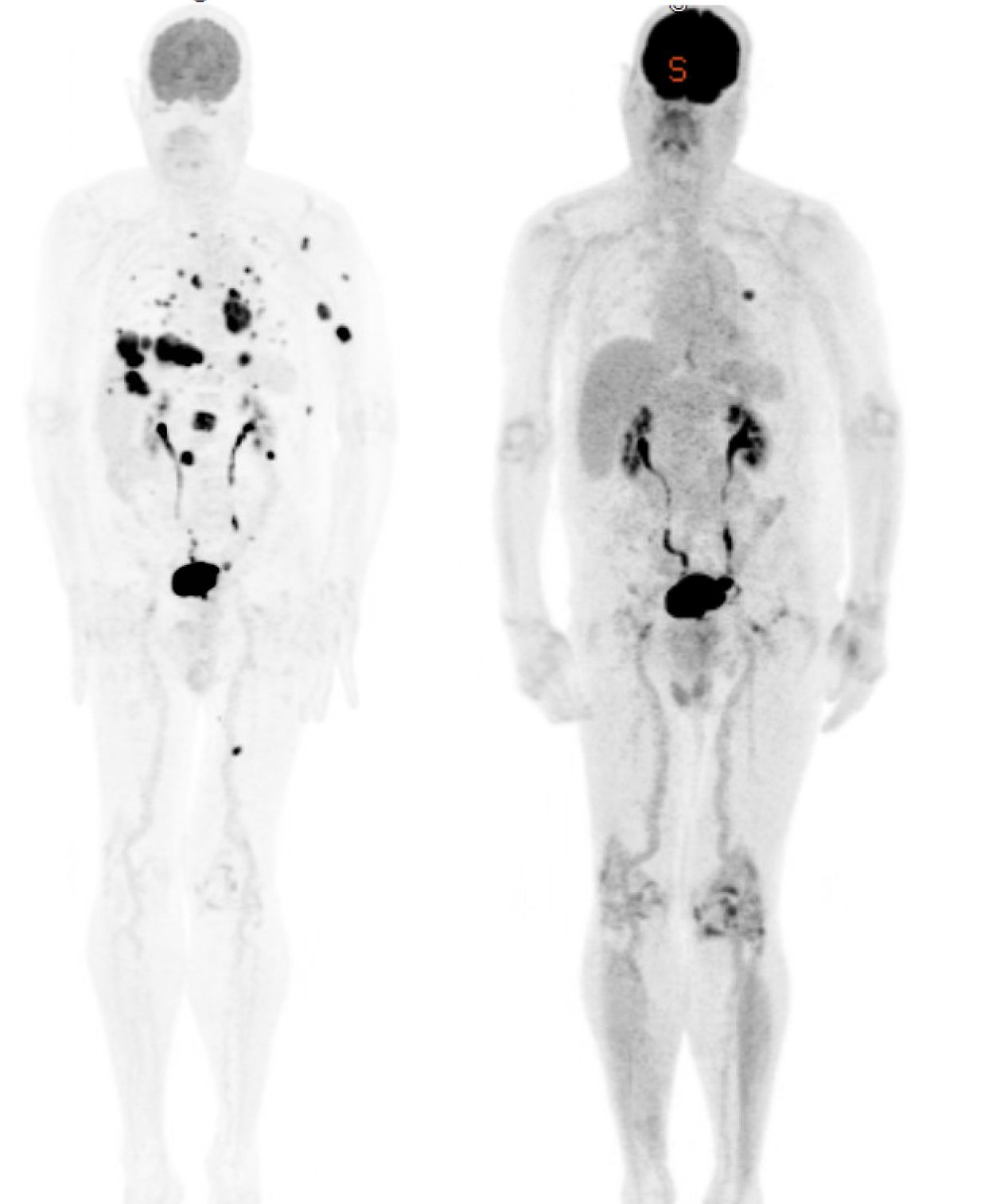 A PET scan in a patient with melanoma showing an excellent response to treatment with immunotherapy. Melanoma response to Pembrolizumab, Keytruda