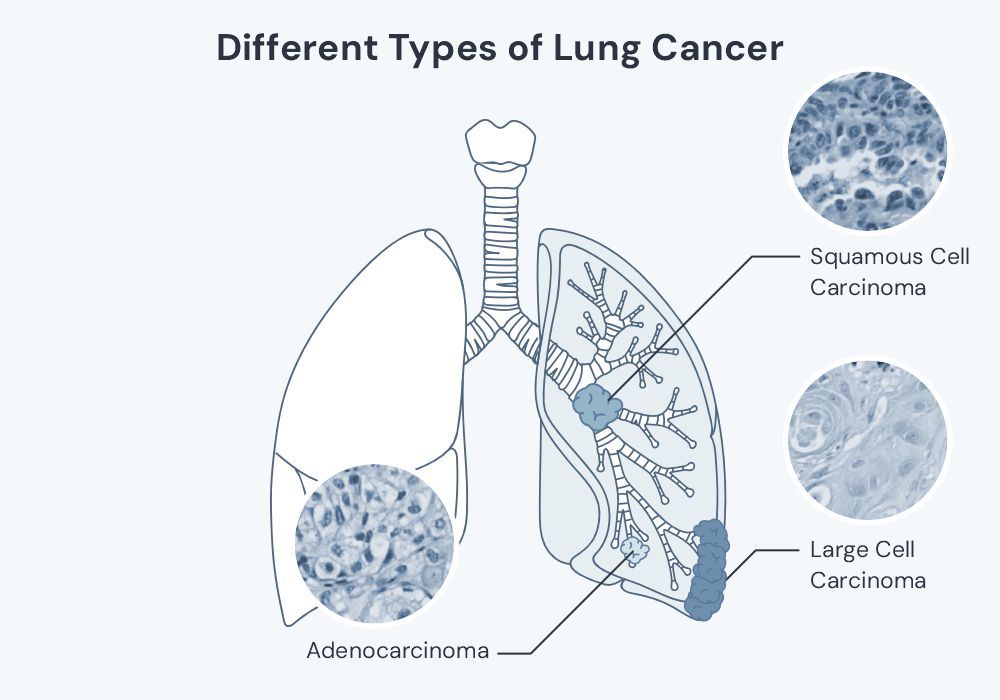 A cartoon showing the difference between different types of non-small cell lung cancer - squamous cell carcinoma, adenocarcinoma and large cell carcinoma