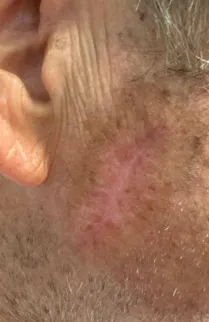 A basal cell carcinoma on the cheek after radiotherapy