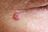 Radiotherapy or Surgery for Skin Basal Cell Carcinoma?