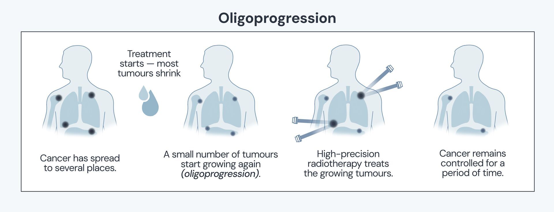 Infographic describing what oligoprogression is and how stereotactic radiotherapy can be used to treat people with Stage 4 cancer and keep people on treatment for longer e.g. lung cancer remission