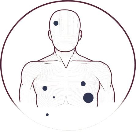 Metastatic melanoma can be treated with immunotherapy and targeted therapies.