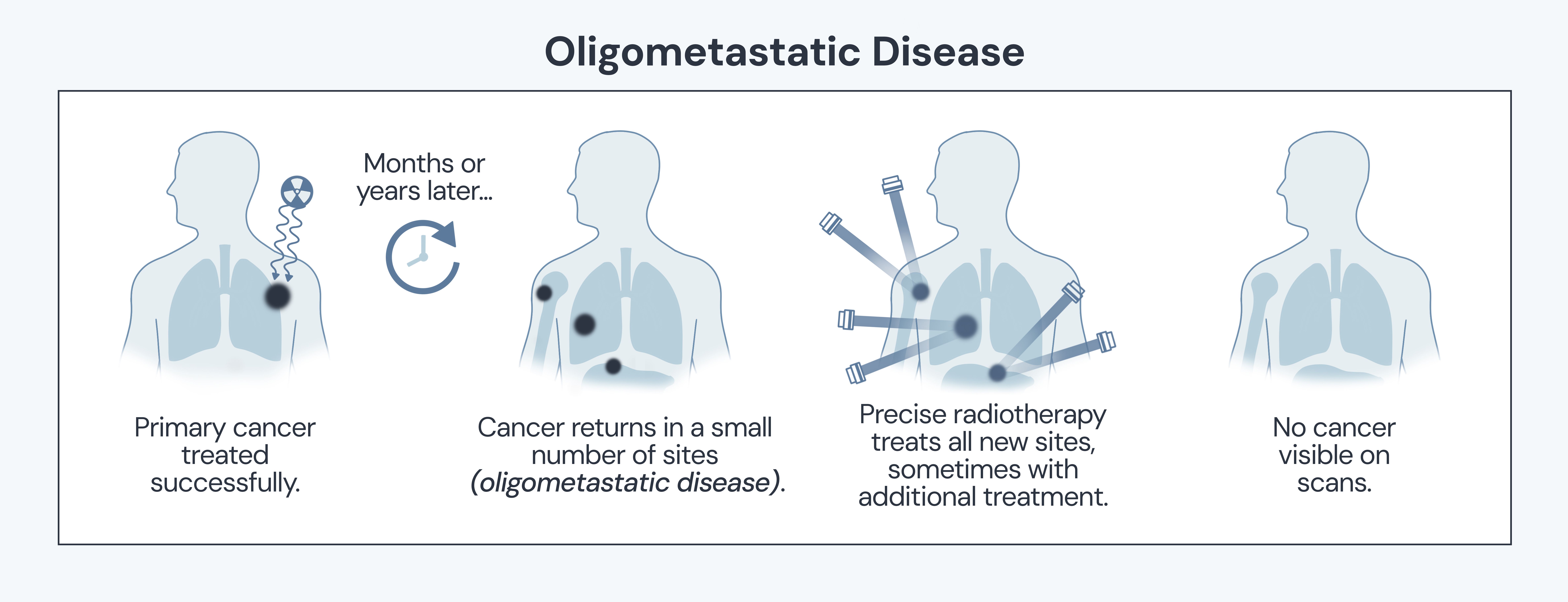 What is metastatic cancer? An image showing what oligometastatic disease is and defining the treatment options