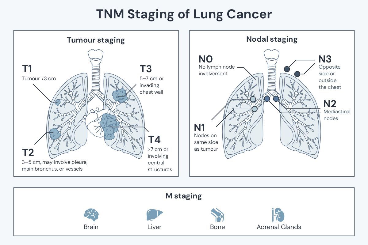 A cartoon of TNM staging for lung cancer used in the staging of non-small cell lung cancer (NSCLC)