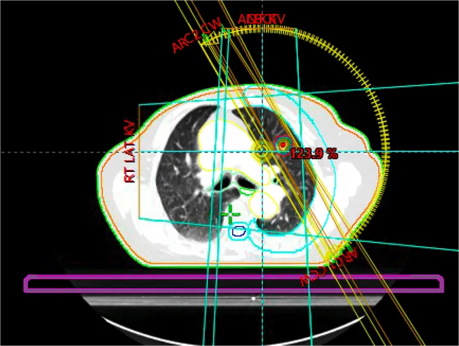 How Successful is Stereotactic Radiotherapy?