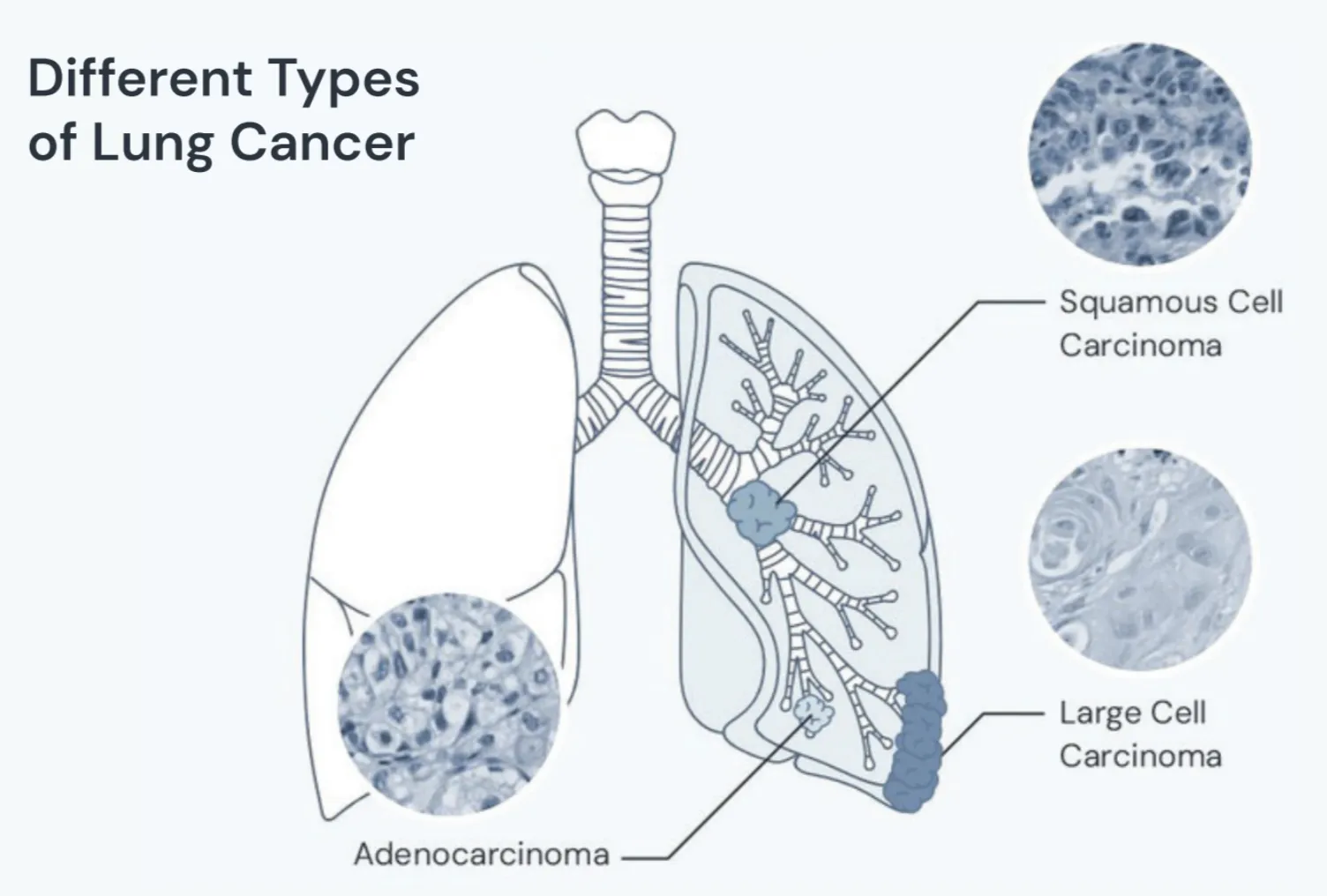 An image showing the different types of non-small cell lung cancer. Adenocarcinoma, squamous cell carcinoma and large cell carcinoma