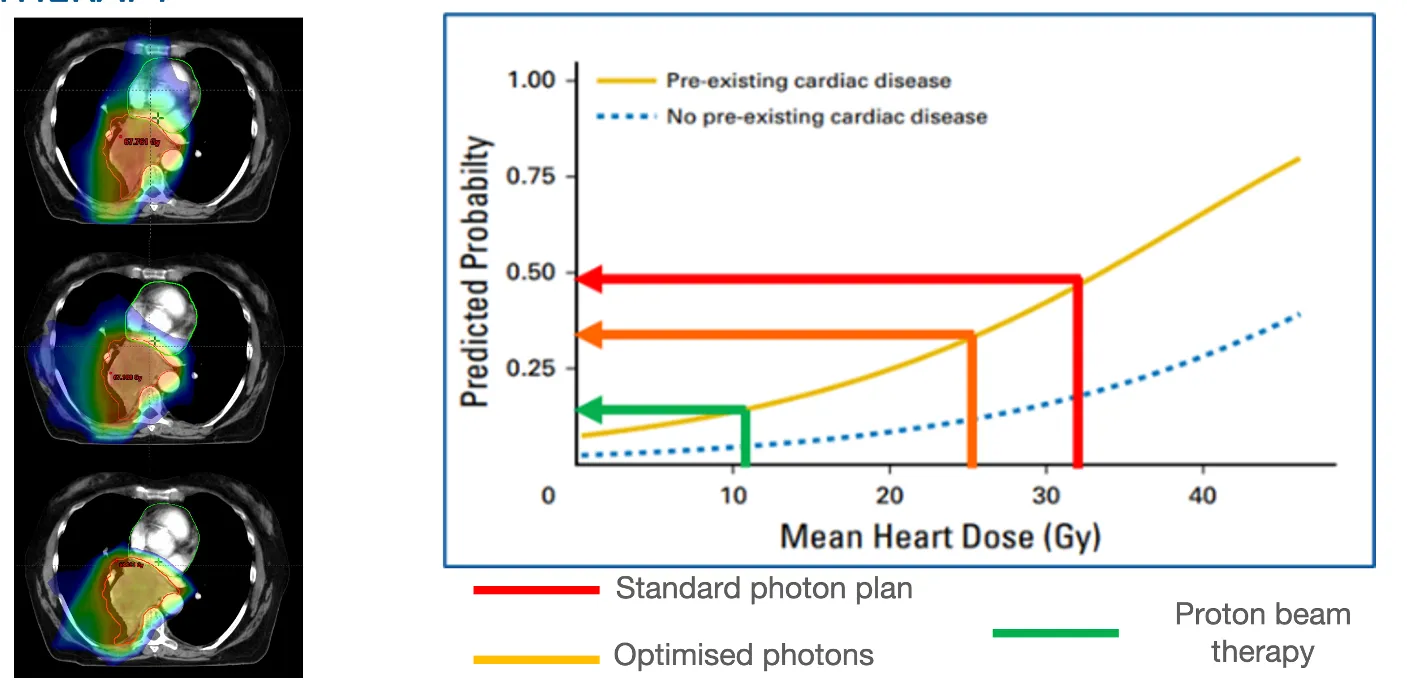 Some research conducted by Dr Wilson showing that proton beam therapy for lung cancer can reduce the radiation dose to the heart