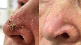 ## What skin cancer on the nose may look like