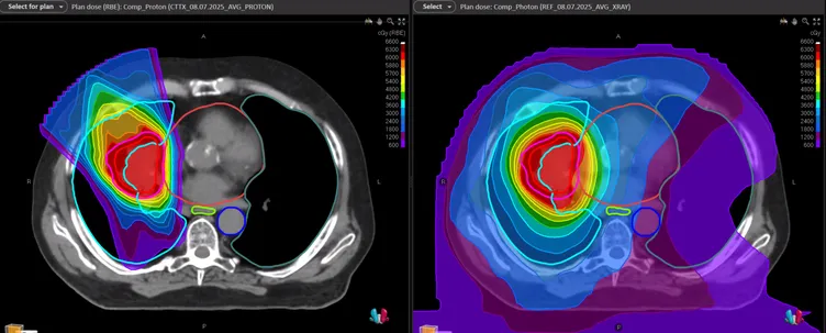 Comparison of proton beam therapy and standard photon radiotherapy treatment plans for lung cancer. The left image shows a proton beam therapy dose distribution with sharply defined contours and reduced radiation exposure to surrounding healthy tissue, while the right image shows a conventional photon (X-ray) plan with a broader spread of lower-dose regions. Illustrates the precision and potential benefits of proton beam therapy for lung cancer in reducing side effects and protecting the heart and lungs. Relevant to patients seeking the best treatment for lung cancer or private lung cancer treatment in the UK.