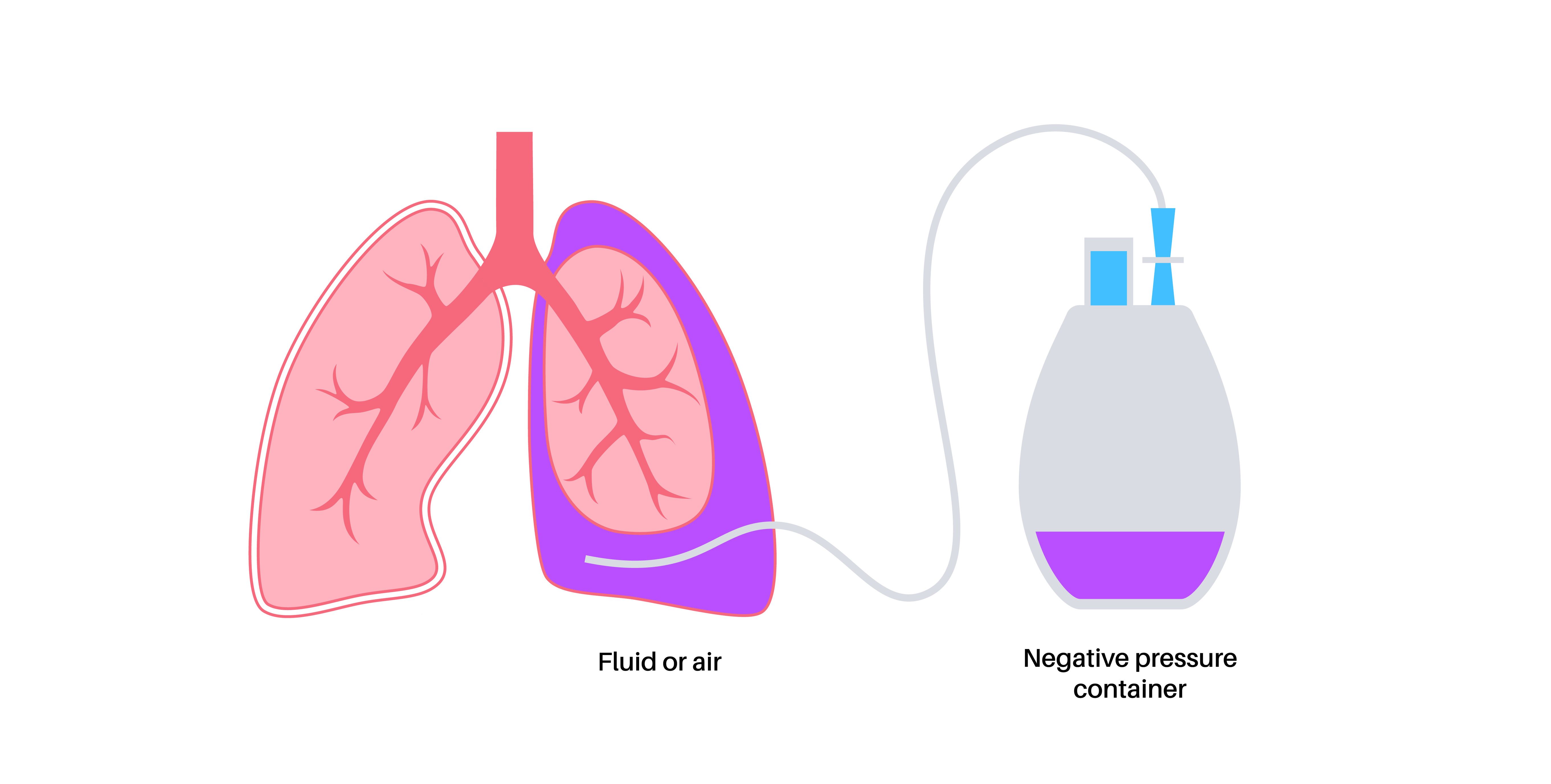 Illustration showing how an indwelling pleural catheter works to drain pleural effusion from the chest cavity into a collection bottle using negative pressure