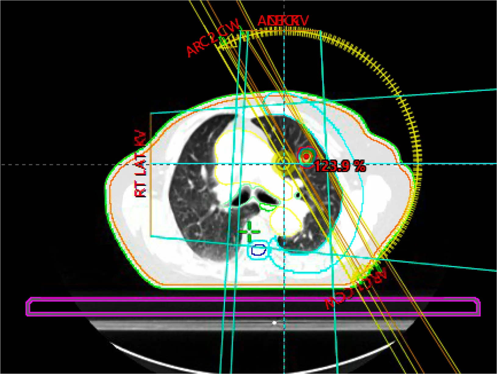 Stereotactic radiotherapy is a highly effective treatment for lung cancer. Offers Stage I lung cancer survival rates of 90%