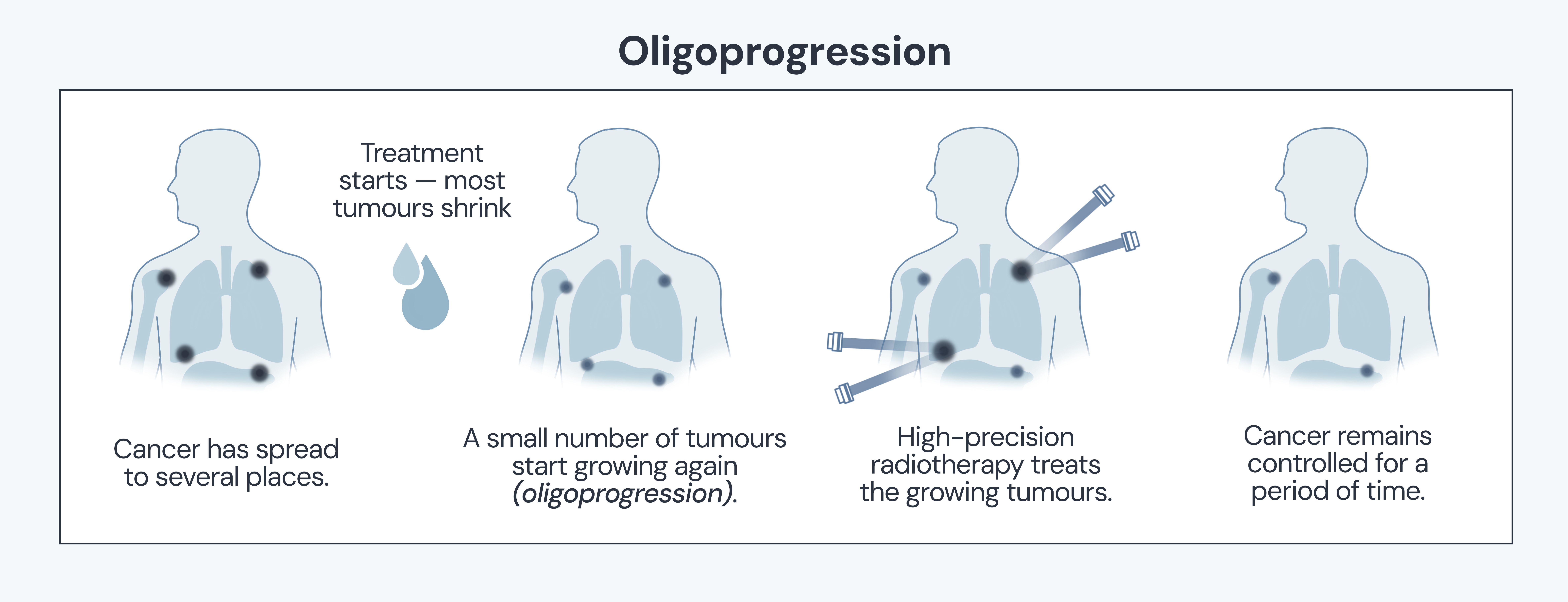 What is oligoprogression? What treatment options do I have once my cancer starts growing?