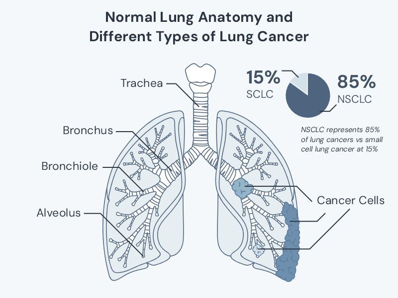 A diagram showing normal lung anatomy and the different types of lung cancer - small cell and non-small cell lung cancer