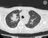 The Evolving Success of Lung Cancer Treatment