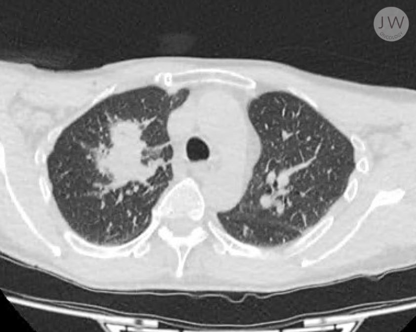 The Evolving Success of Lung Cancer Treatment