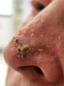 A basal cell carcinoma case before radiotherapy