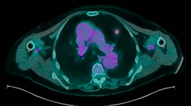 Early Stage Lung Cancer: Expert Care with Dr Wilson