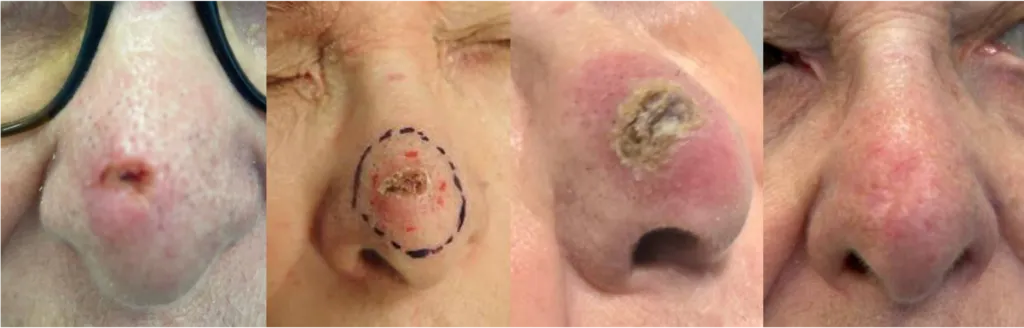 Basal cell carcinoma treatment. Radiotherapy for skin cancer. Side effects of radiotherapy for skin cancer. Curing basal cell carcinoma