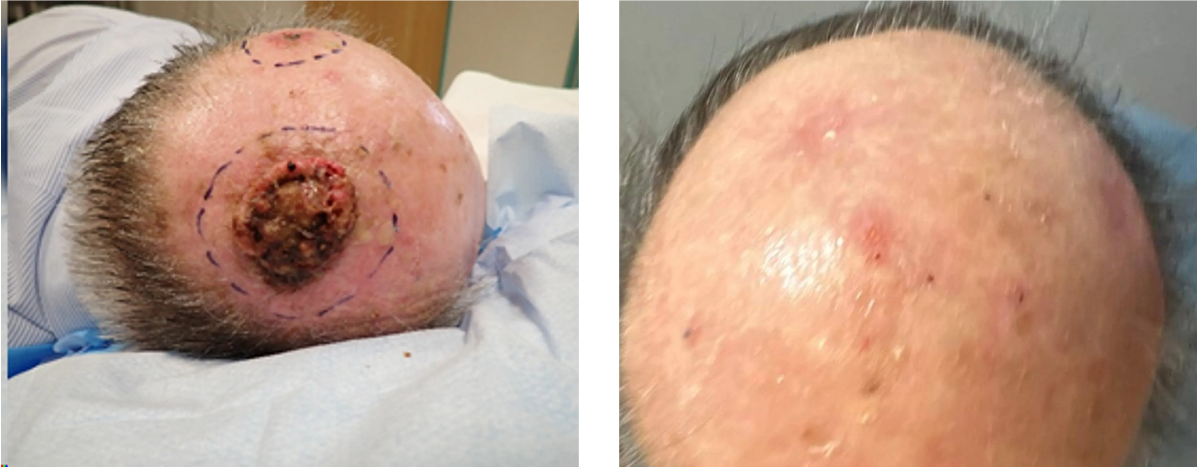 Basal Cell and Squamous Cell Skin Cancer Treatment: An Educational Resource