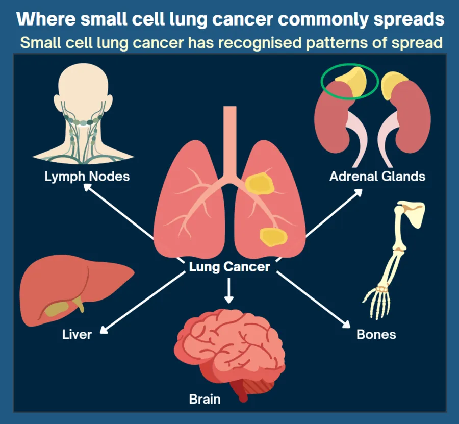 Where small cell lung cancer commonly spreads