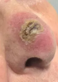 A basal cell carcinoma on the nose before radiotherapy