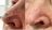 Basal Cell and Squamous Cell Skin Cancer Treatment: An Educational Resource