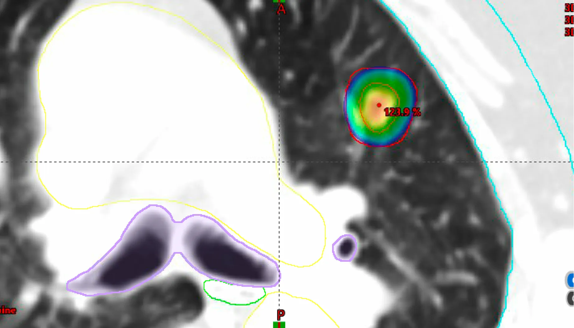 A picture of a radiotherapy plan for stereotactic radiotherapy for lung cancer showing the highly accurate, high dose treatment.