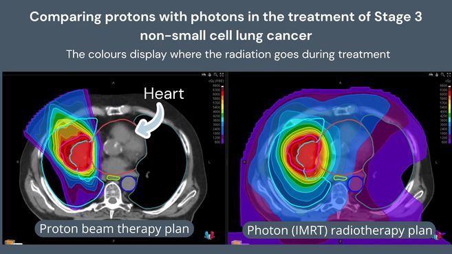 Benefits of Proton Beam Therapy For Lung Cancer