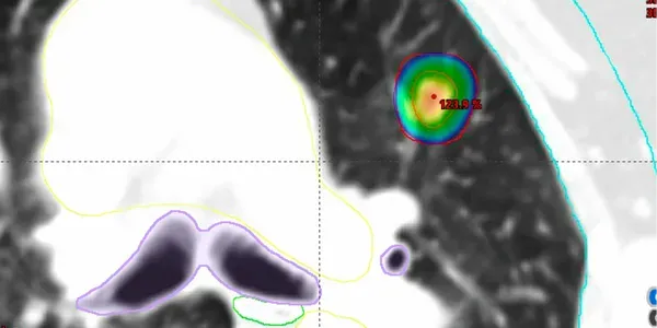 Stereotactic Radiotherapy (SABR) for Lung Cancer