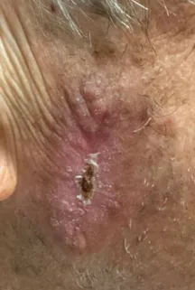 A basal cell carcinoma on the cheek before radiotherapy