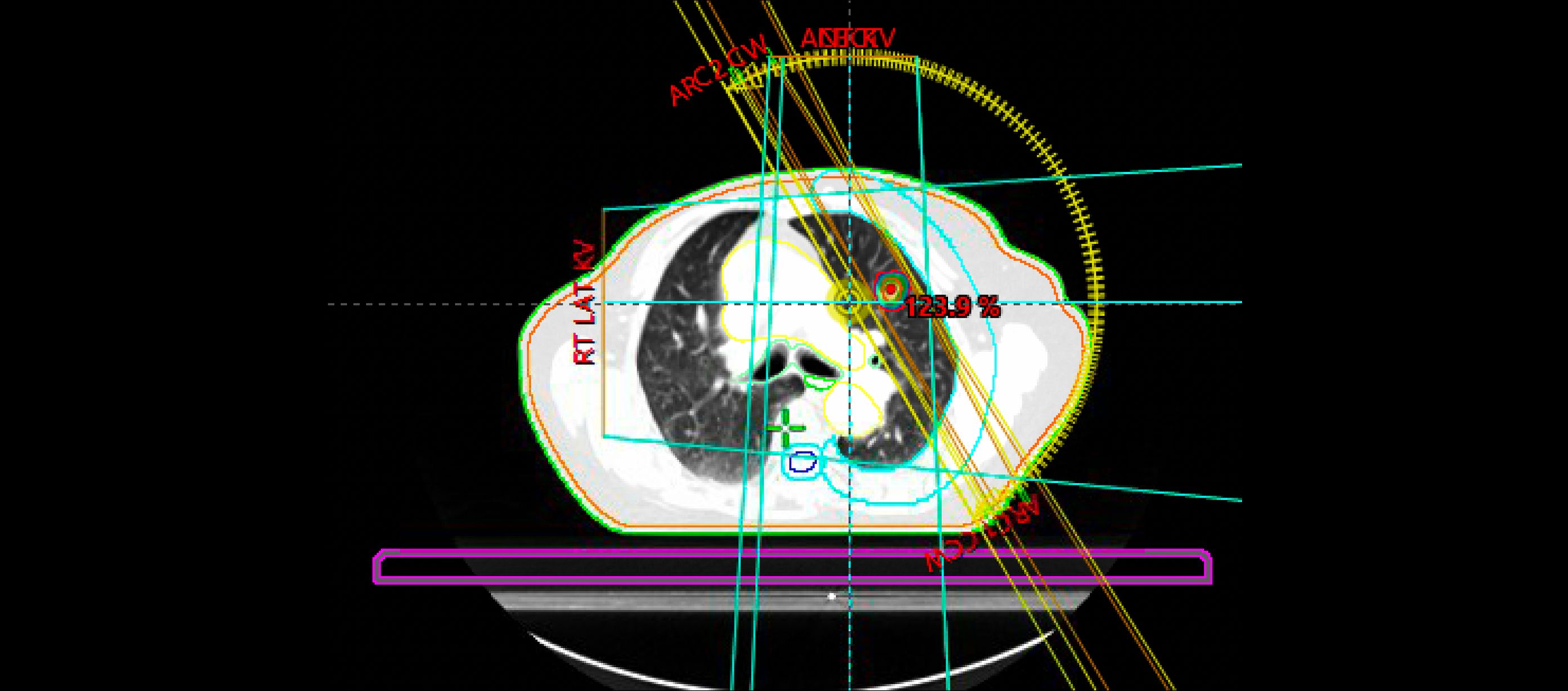 Stereotactic radiotherapy is a highly effective treatment for lung cancer. Offers Stage I lung cancer survival rates of 90%