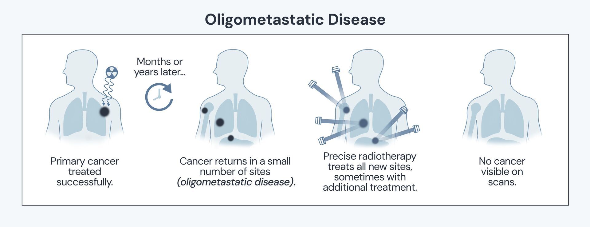 Infographic showing how Dr James Wilson treats Stage 4 cancer with stereotactic radiotherapy at private hospitals in London