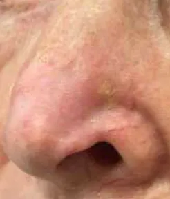 A basal cell carcinoma case after radiotherapy