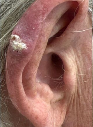 A squamous cell carcinoma on the ear