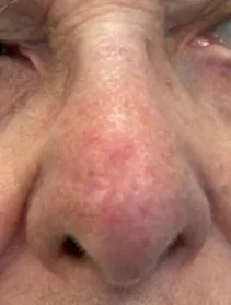 A basal cell carcinoma on the nose after radiotherapy