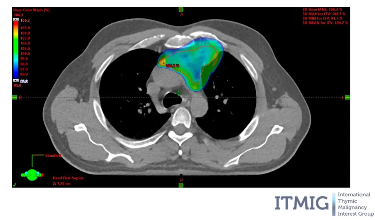 Radiotherapy for Thymoma