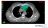 Radiotherapy for Thymoma