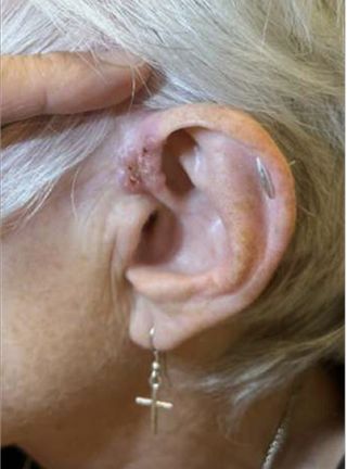 A basal cell carcinoma on the skin