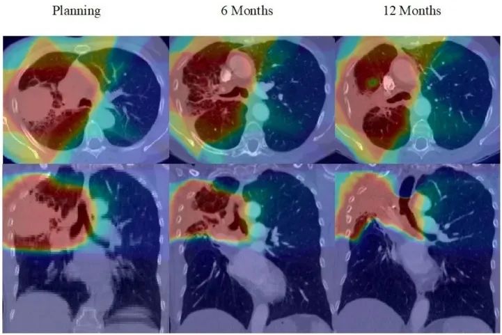 Long-Term Side Effects of Lung Cancer Radiotherapy: What You Need to Know