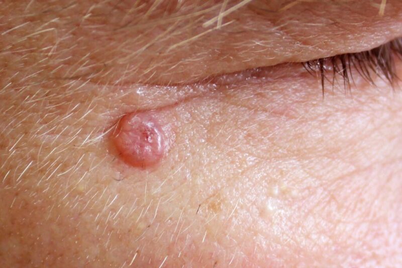 basal cell carcinoma. BCC on the face