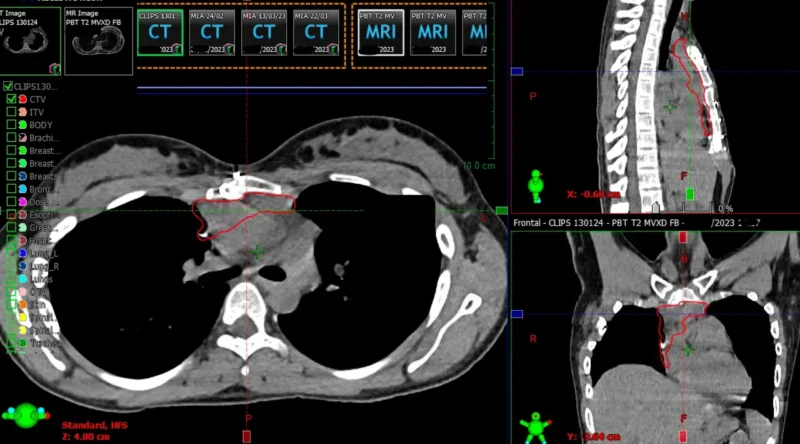 Thymoma treatment