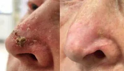 A photograph of a nose before and after radiotherapy for skin cancer - a basal cell carcinoma, BCC.