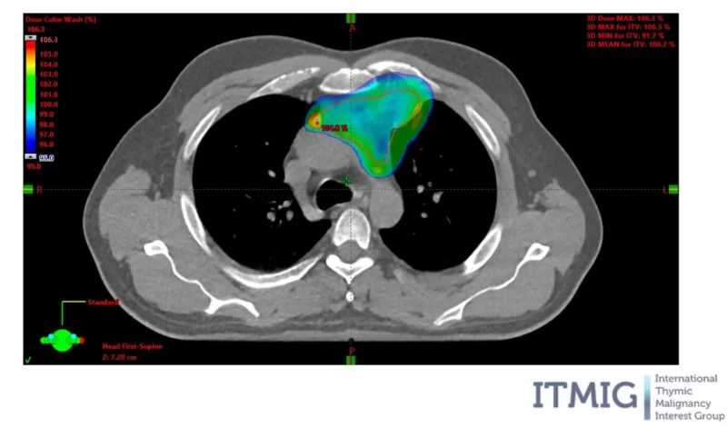 Radiotherapy for thyoma