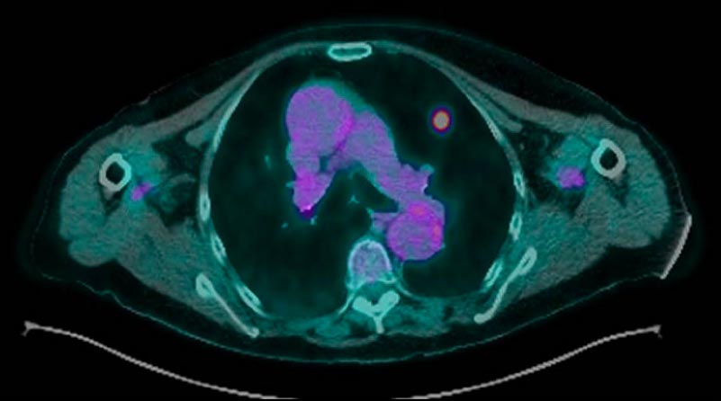 lung cancer imaging shows suitability for stereotactic radiotherapy