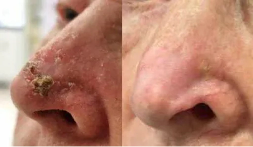 BCC before and after radiotherapy. Basal cell carcinoma on the nose. Successful treatment of BCC