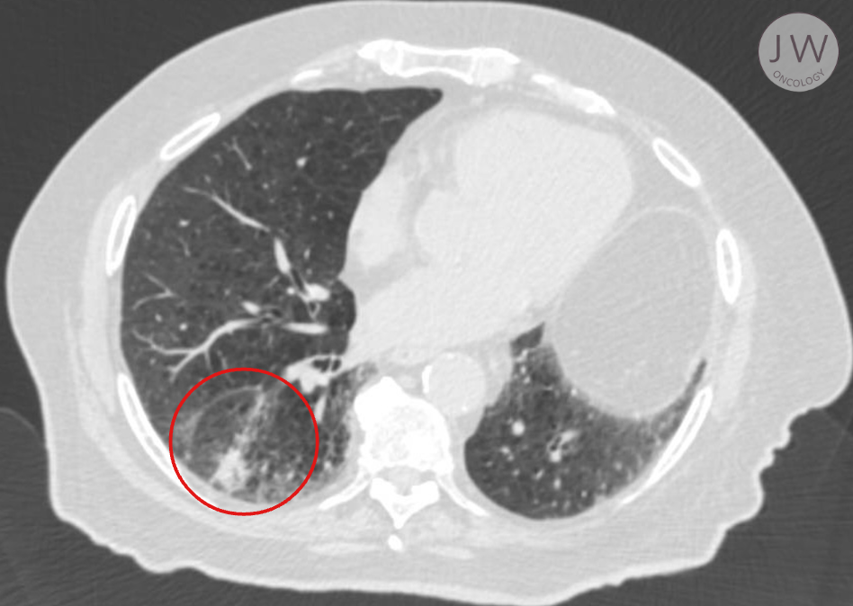 Image of a patient's lungs, highlighting the cancer.