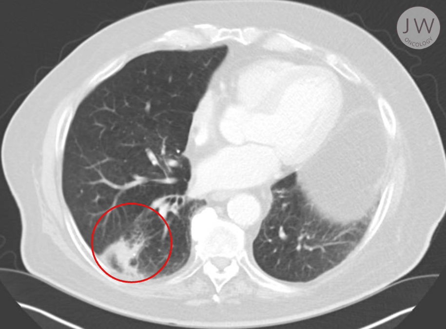 Image of a patient's lungs, highlighting the has been eliminated.