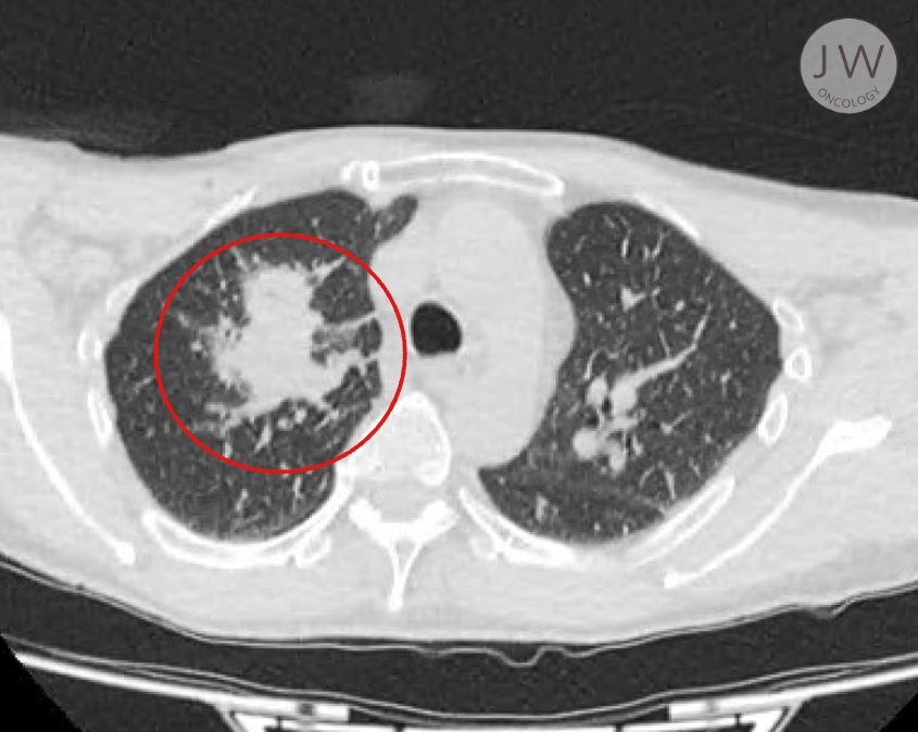 Image of a patient's lungs, highlighting the large tumour.