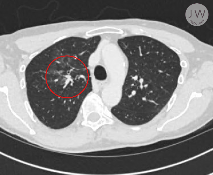 Image of a patient's lungs, highlighting the success of the surgery.